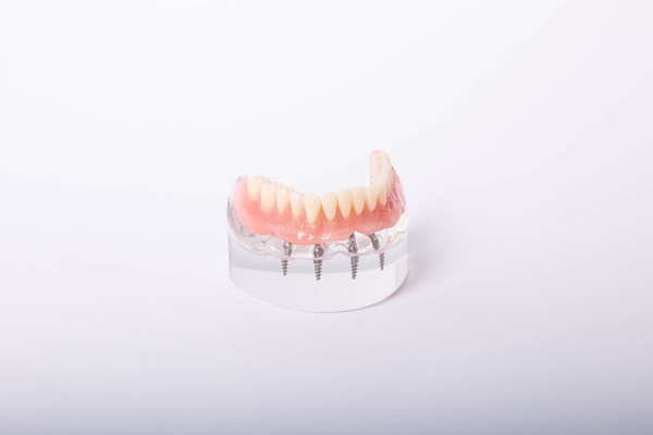 Do All On  ® Implants Look Natural?