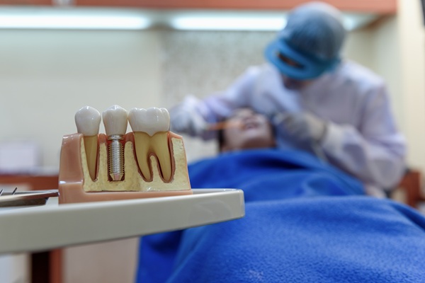 Dental Implant Placement Surgery FAQs