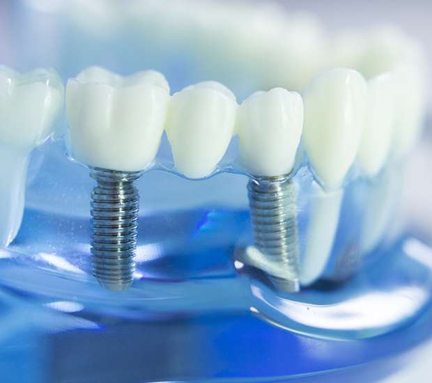 Woodstock Dental Implants