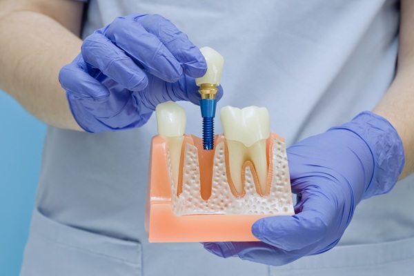 Aftercare Instructions From An Implant Dentist
