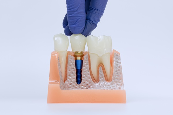 Ask An Implant Dentist About Natural Vs Artificial Teeth