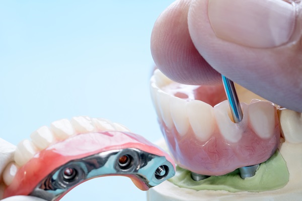 Why You Should Choose Implant Supported Dentures
